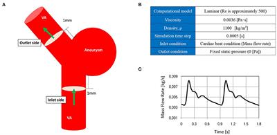 Possibility of Worsening Flow Diversion Effect Due to Morphological Changes of a Stented Artery With Multiple Overlapping Stents for Partially Thrombosed Vertebral Artery Aneurysms